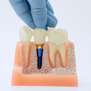 ZIRCONIA CROWN ON IMPLANT (10 YRS)